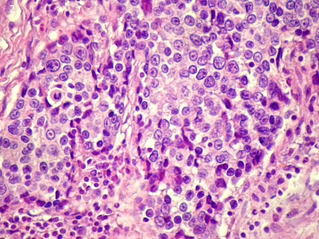 2.-abra-Grade-III-as-emlomirigy-carcinomarak-tomor-solid-daganatsej-szigetekkel-.jpg